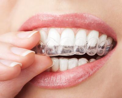 girl putting on Invisalign in Jacksonville FL