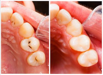 tooth-colored fillings in Jacksonville, FL