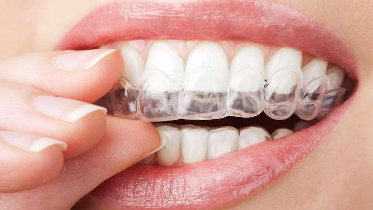 girl putting on Invisalign clear braces in jacksonville fl