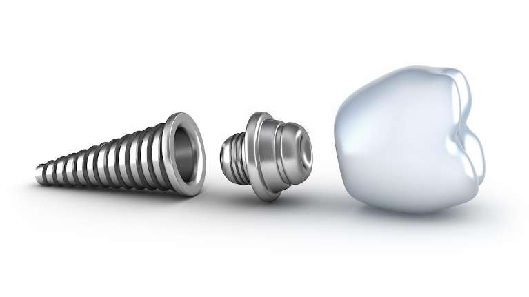 image of a dental implant in jacksonville fl
